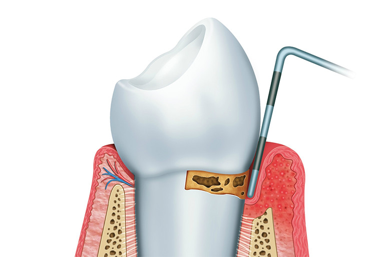 歯周病治療・予防診療